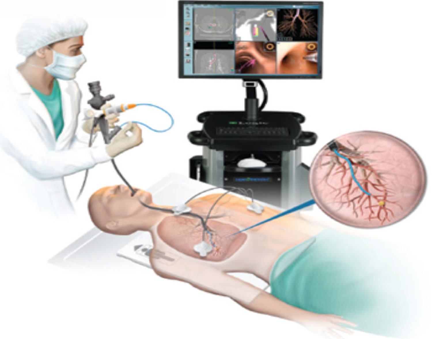 Bronchoscopy